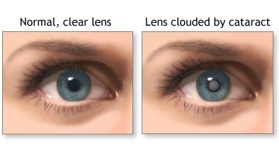 Eye with cataract / Ojo con catarata