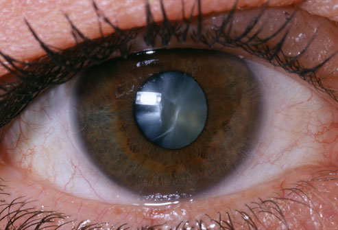 Eye with cataract / Ojo con catarata