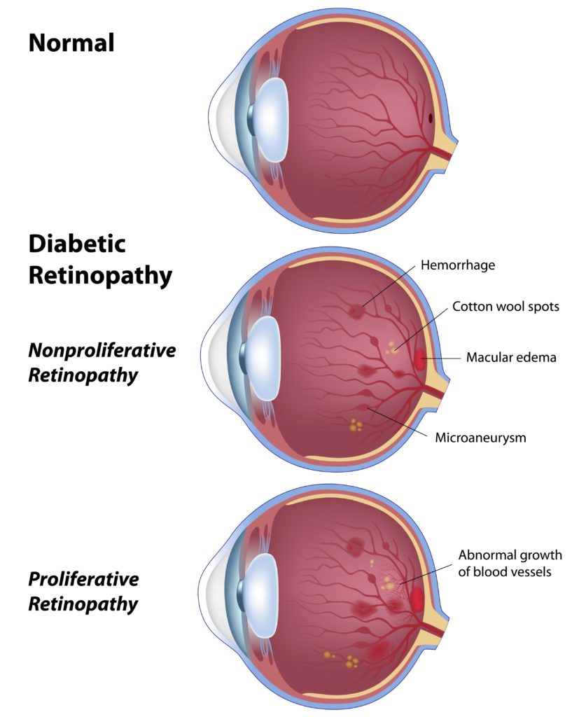 Retinopatía diabética