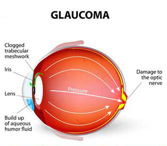 Glaucoma